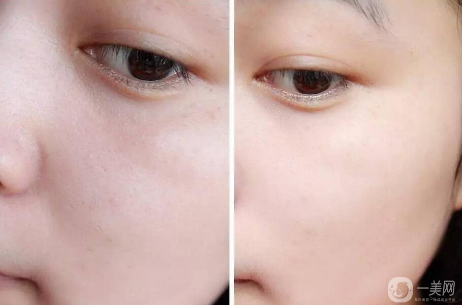 嫩膚多少錢 醫(yī)療美容嫩膚價(jià)格詳解