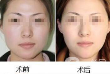 去頰脂墊多久消腫 去頰脂幾天能恢復