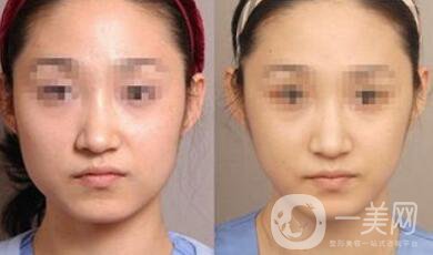 去頰脂墊多久消腫 去頰脂幾天能恢復