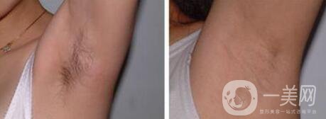 激光脫毛價(jià)格在多少 激光脫毛費(fèi)用詳解