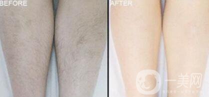 激光脫毛價(jià)格在多少 激光脫毛費(fèi)用詳解