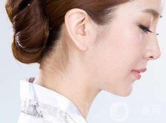 廣東鼻翼寬整形多少錢 鼻翼寬整形價格