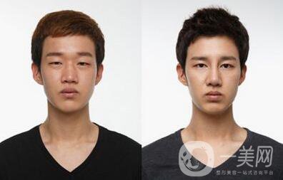 男生割雙眼皮會變帥嗎？