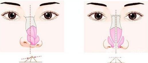 鼻子歪了矯正有危險(xiǎn)嗎？