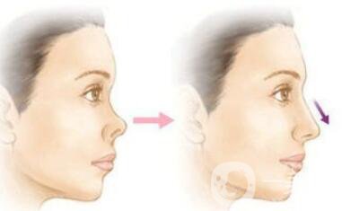 矯正朝天鼻多少錢 朝天鼻矯正價(jià)格詳解