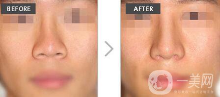 矯正朝天鼻多少錢 朝天鼻矯正價(jià)格詳解