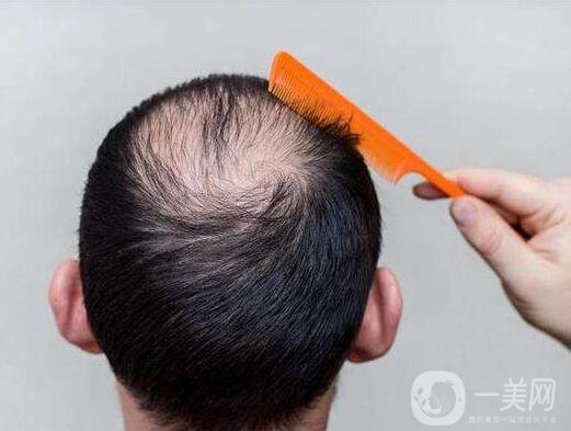 fut植發(fā)技術(shù)怎么樣 fut植發(fā)技術(shù)好不好