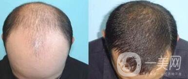 fue植發(fā)*果 頭發(fā)種植*果怎么樣