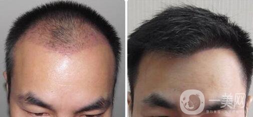 fue植發(fā)*果 頭發(fā)種植*果怎么樣