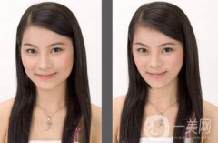 下頜角截骨手術(shù)會復(fù)發(fā)嗎？