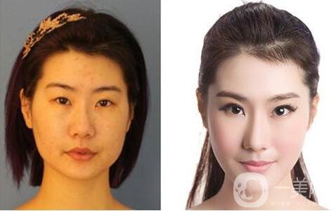 下頜角截骨手術(shù)會(huì)復(fù)發(fā)嗎？