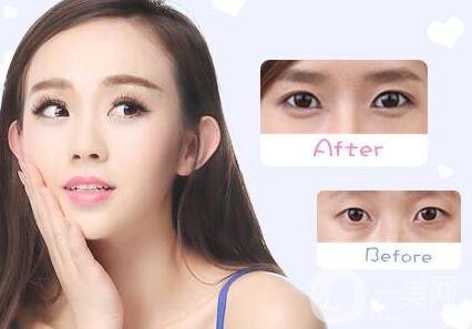 上海,韓式三點(diǎn)雙眼皮,價(jià)格