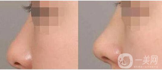 上海,玻尿酸隆鼻,價錢