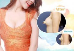 隆胸術(shù)后的后遺癥有哪些 隆胸有哪些風(fēng)險