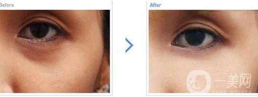 玻尿酸去黑眼圈,術后護理