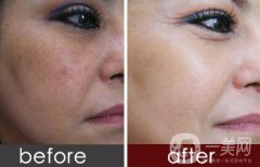 去黃褐斑多少錢 去除黃褐斑價(jià)格介紹