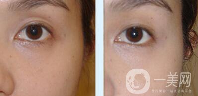 自體脂肪豐眼窩缺點(diǎn) 自體脂肪豐眼窩為什么不好