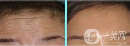 去除抬頭紋的價(jià)錢(qián) 去抬頭紋大概多少錢(qián)