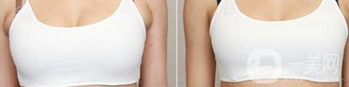 做附乳祛除手術(shù)一般需要多少錢(qián)
