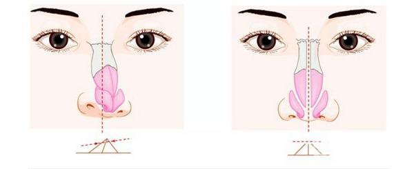 做一次歪鼻矯正手術(shù)價(jià)格需要多少錢？