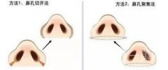 蒜頭鼻整形要多少錢 蒜頭鼻整形價(jià)格