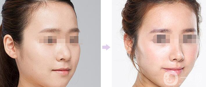 蒜頭鼻整形要多少錢 蒜頭鼻整形價格