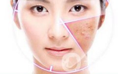 做果酸換膚多少錢一次 果酸換膚具體價(jià)格