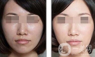 做果酸換膚多少錢一次 果酸換膚具體價(jià)格