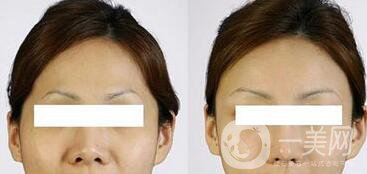 豐太陽穴多少錢 太陽穴填充具體價(jià)格