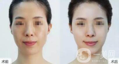 豐太陽穴多少錢 太陽穴填充具體價(jià)格