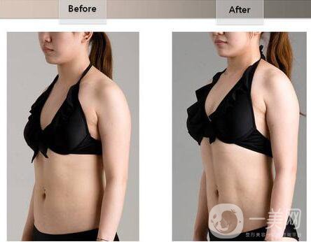 抽脂形體改良怎么做 抽脂形體改良方法是什么