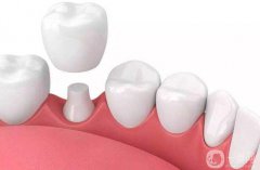 貴金屬烤瓷牙多少錢一顆 貴金屬烤瓷牙一顆的價(jià)格