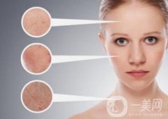 *風(fēng)范祛斑多少錢一次 與哪些因素有關(guān)？