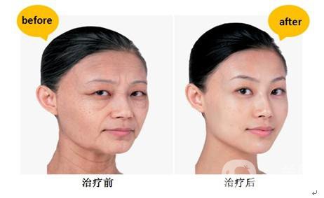 *生物除皺*果怎么樣？能持續(xù)多久？