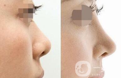 *術(shù)后注意事項(xiàng) *整形術(shù)后如何護(hù)理