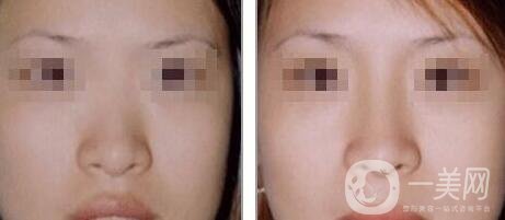 隆鼻后消腫的方法 隆鼻后怎么護(hù)理恢復(fù)快
