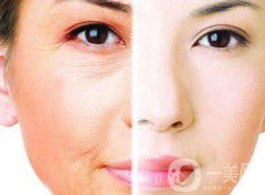 祛皺多少錢 祛皺價(jià)格一般是多少