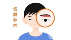 上海一般切眉需要多少錢 價(jià)格分析參考