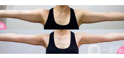 做上臂吸脂術(shù)后小臂腫怎么辦?