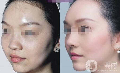 *恢復期注意事項 *術(shù)后護理