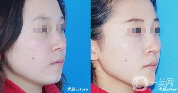 *恢復期注意事項 *術(shù)后護理