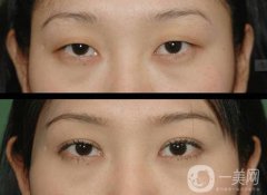 北京哪家醫(yī)院割雙眼皮果好？