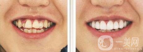 哪種烤瓷牙比較好 烤瓷牙修復圖