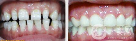 哪種烤瓷牙比較好 烤瓷牙修復圖