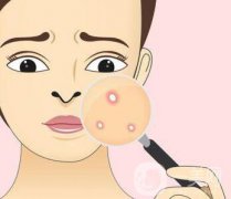 快速*去痘印的方法有哪些？