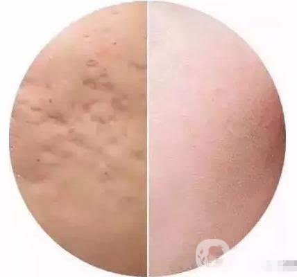 快速*去痘印的方法有哪些？