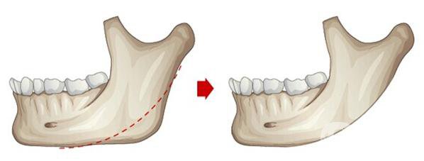 磨骨手術(shù)做完有些什么后遺癥？