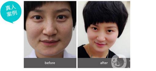 磨骨手術(shù)做完有些什么后遺癥？