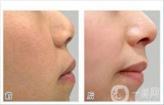 光子嫩膚前后*果嗎 果怎么樣？