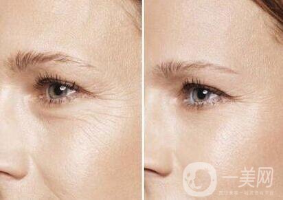 *去魚尾紋多少錢 價(jià)格是多少